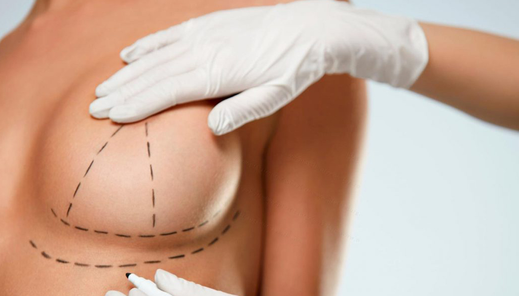 Mamoplastia - Dr Ricardo Lizardo